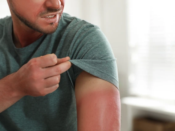 A person with a sunburn lifts up his T-shirt sleeve.