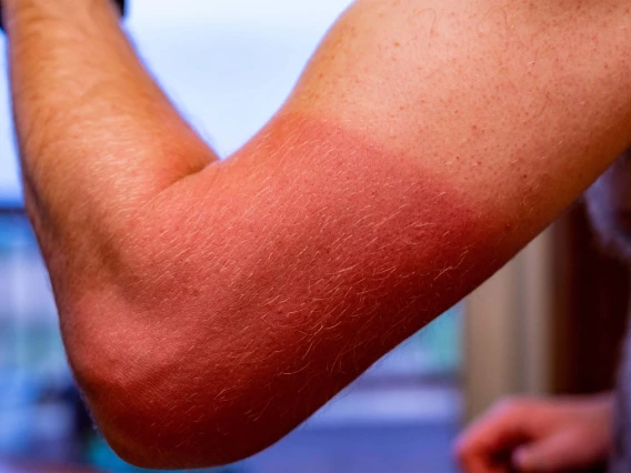 Prolonged sun exposure can lead to the development of cutaneous squamous cell carcinoma, a skin cancer that College of Medicine – Phoenix researchers are working to prevent.