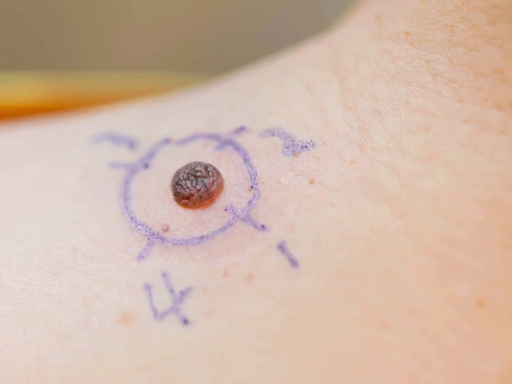 University of Arizona researchers want to develop topical treatments that can activate the body’s own immune defenses to prevent cancer before it starts, reducing the need for invasive surgeries.