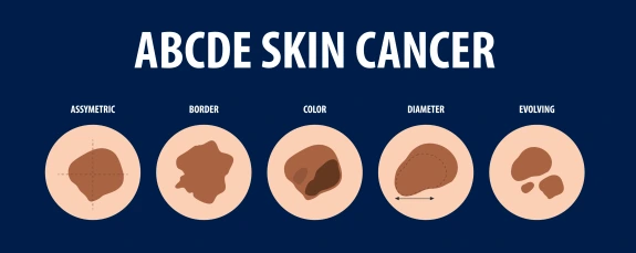 ABCDE's of skin cancer