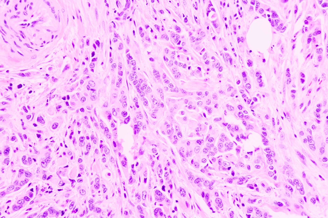 Ductal cell carcinoma, adenonocarcinoma from human breast cancer