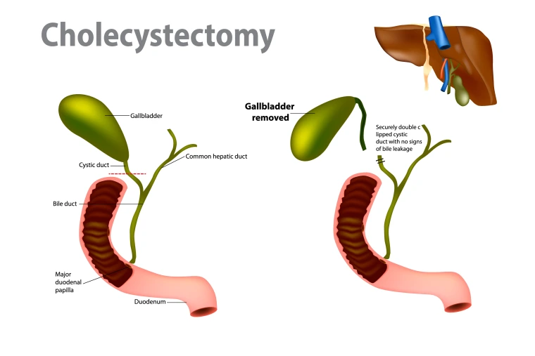 Diagram of a cholecystectomy.