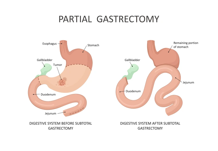 Diagram of a partial gastrectomy