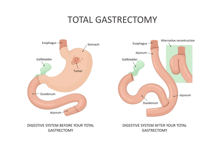 Diagram of a total gastrectomy.