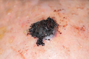 An image of malignant melanoma.
