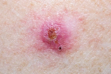 basal cell carcinoma