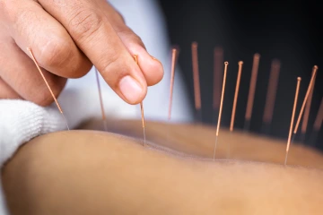 A person undergoes acupuncture.