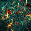 Confocal microscope image of cancer cells and fibroblasts in collagen. Image courtesy of U of A Comprehensive Cancer Center Nikon Center of Excellence microscopy core.