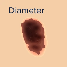 Diameter for skin cancer.