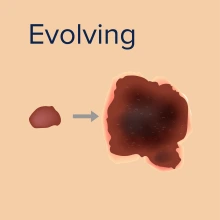 Evolving skin cancer.
